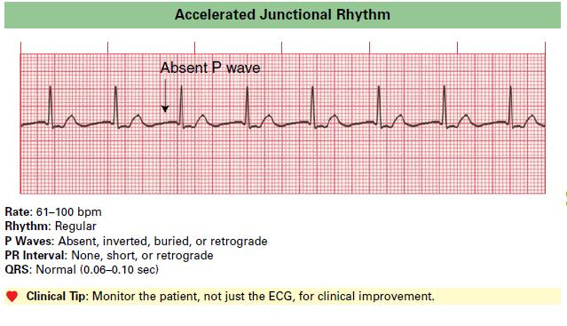 Accelerated Junctional Rhythm