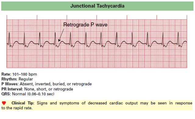 Junctional Tachycardia