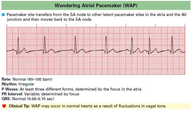 Wandering Atrial Pacemaker WAP