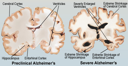 Alzheimers_3