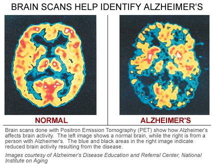 Alzheimers_brain-scan