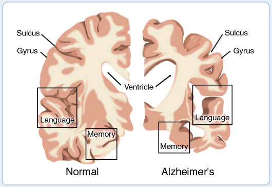 Alzheimers_brain_cross_section_border