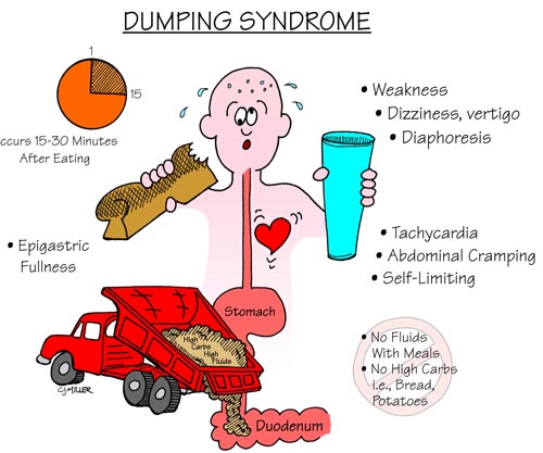 Dumping Syndrome