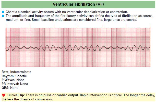 Ventricular_Fibrillation_VF