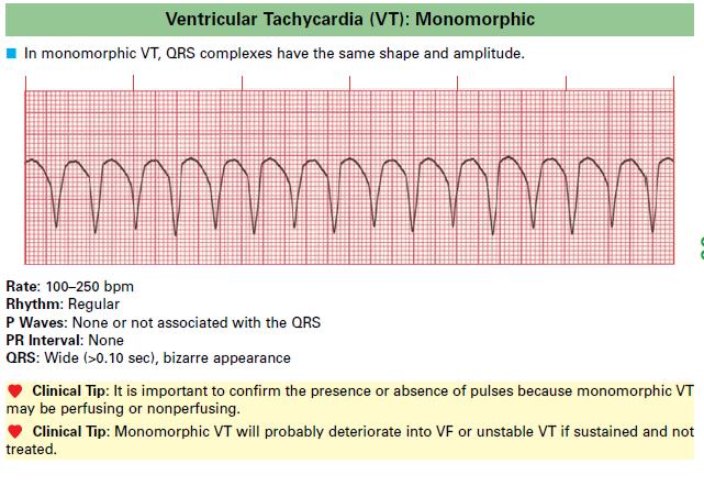 Ventricular_Tachycardia_VT-_Monomorphic
