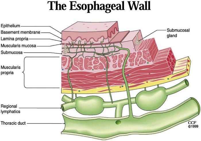 esophageal cancer 1