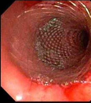 esophageal cancer Endoscopy Stents 1