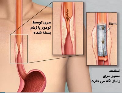 esophageal cancer - Stents