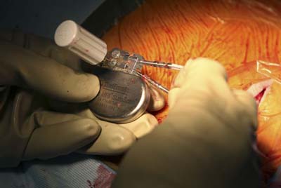 pacemaker_surgery