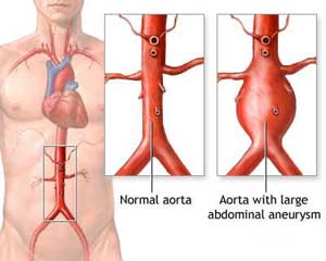 Abdominal Aortic Aneurysm - AAA