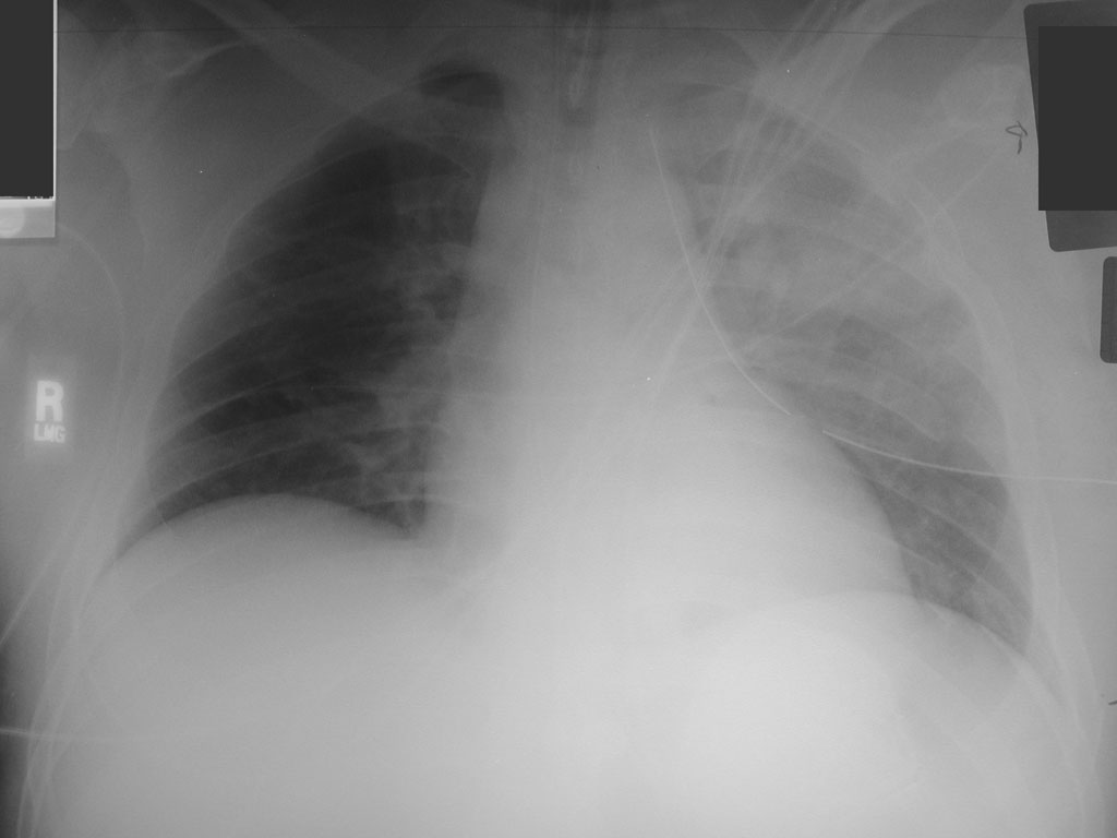 Pulmonary Contusion