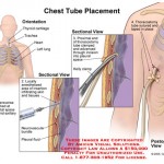 chest tube placement
