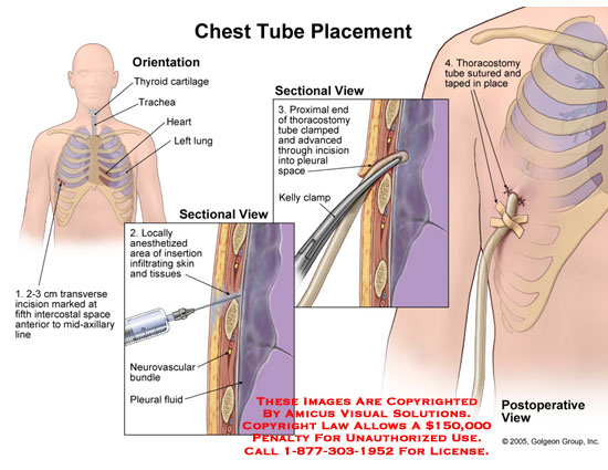 chest tube 1
