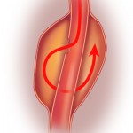Dissection Aortic Aneurysm
