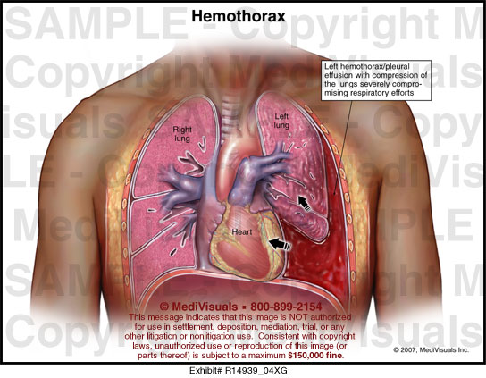 haemothorax