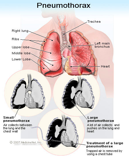 pneumothorax 2