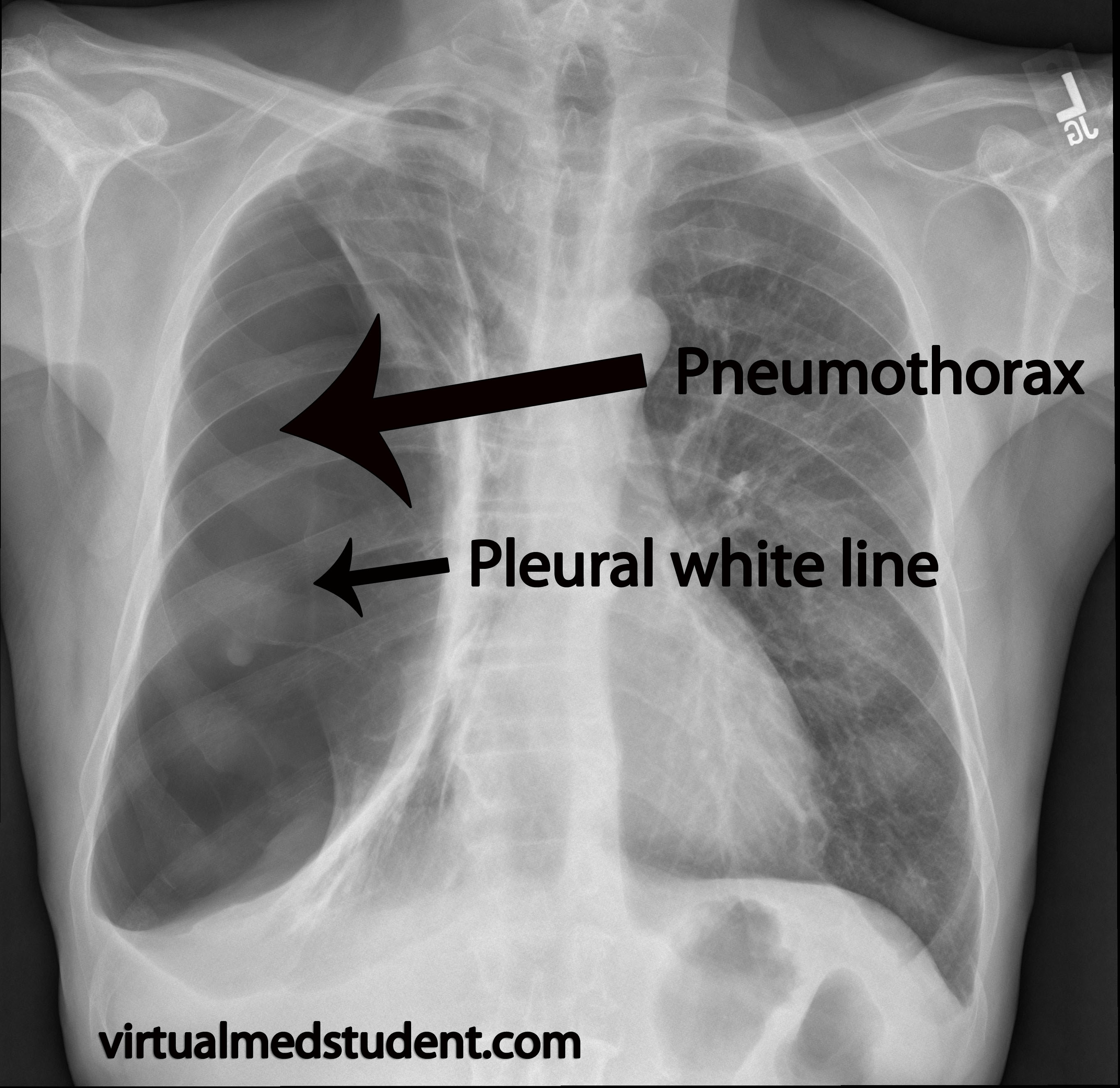 pneumothorax xray