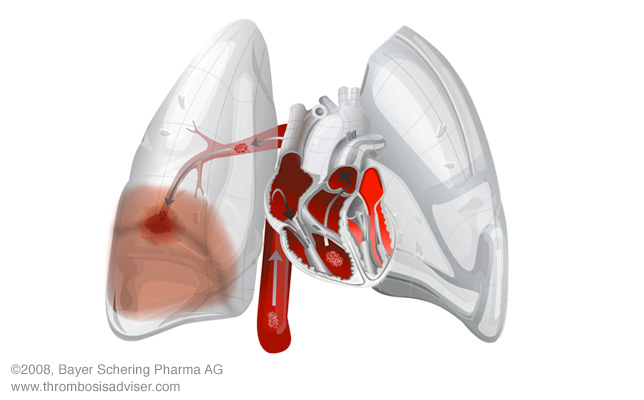 pulmonary embolism 1