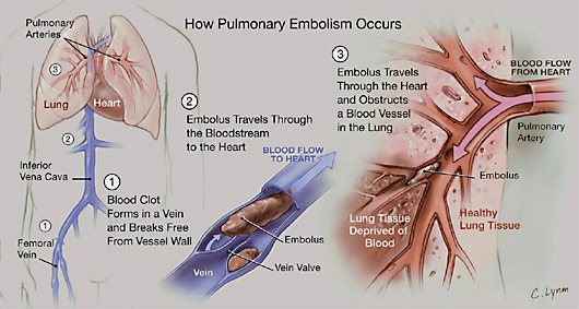 pulmonary embolism 3