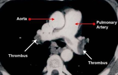pulmonary embolism CT Scane
