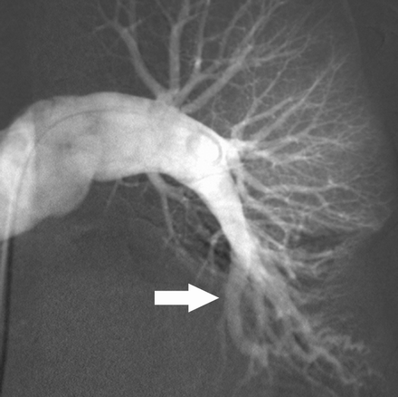 pulmonary embolism angiography