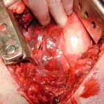 thoracotomy in Open pneumothorax