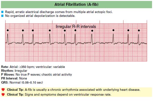 Atrial Fibrillation (A-fib)