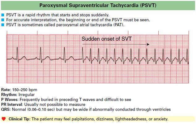 Paroxysmal Supraventricular Tachycardia (PSVT)