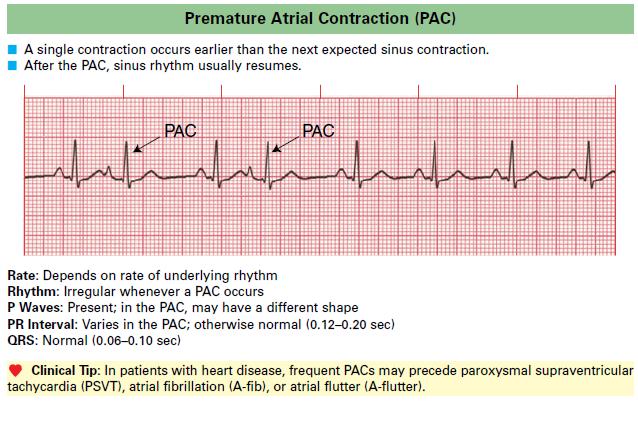 Premature Atrial Contraction (PAC)