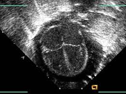 Cardiac Tamponade Ultrasound