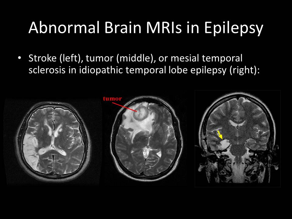 abnormal-brain-mris-in-epilepsy
