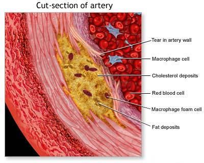 enlarged-view-of-atherosclerosis