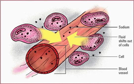 With hypernatremia, the body tries to maintain balance by shifting fluid from the inside of cells to the outside. This illustration shows fluid movement in hypernatremia.