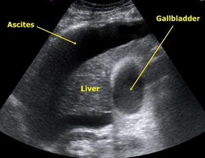 Ascites_Liver_Ultrasound