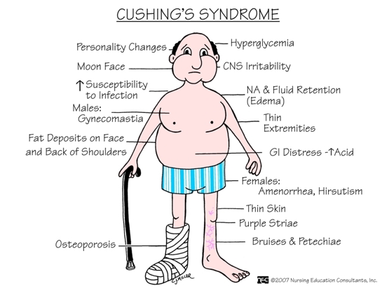 cushings syndrome