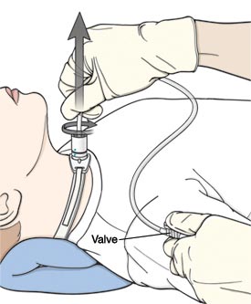 suction-catheter-on-trach-patient-2