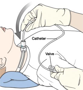 suction-catheter-on-trach-patient