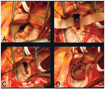 mitral-valve-replacement