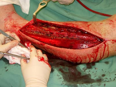 compartment-syndrome-fasciotomy