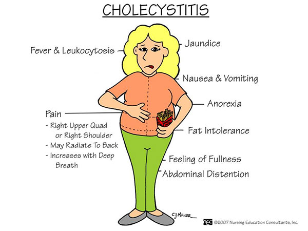 cholecystitis